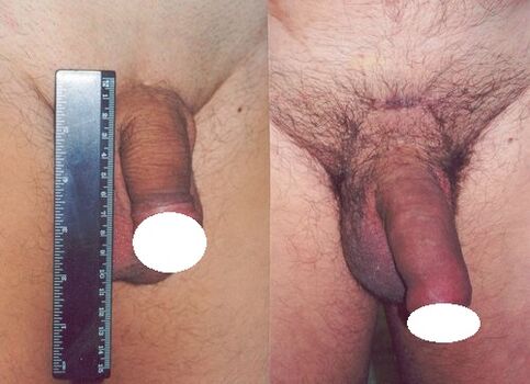 Pene prima e dopo l'aumento